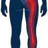 Sciatica